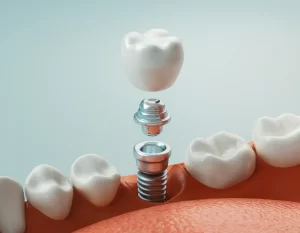 Implanty dentystyczne Szczecin
