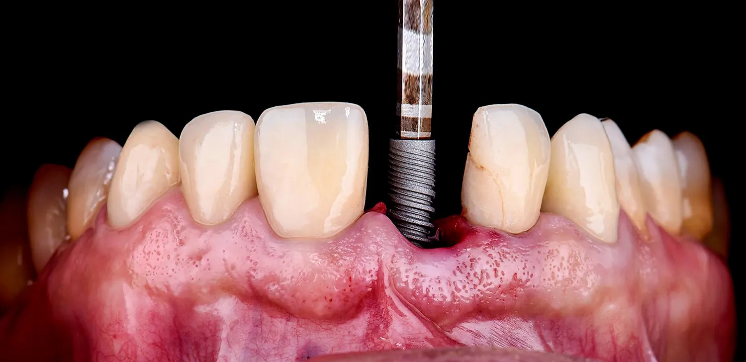 Kiedy po wyrwaniu zęba można wstawić implant?