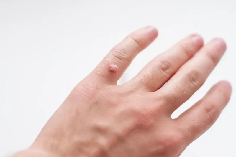 Help 4 skin kurzajki jak stosować?